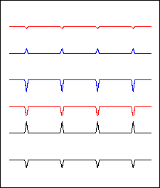 fehlerhaftes EKG