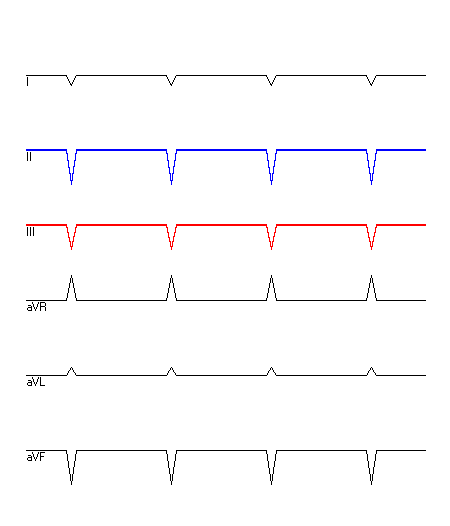 EKG mit hervorgehobenen Ableitungen