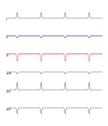 EKG mit hervorgehobenen Ableitungen