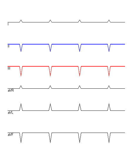 EKG mit hervorgehobenen Ableitungen
