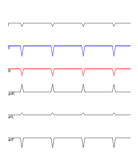 EKG mit hervorgehobenen Ableitungen
