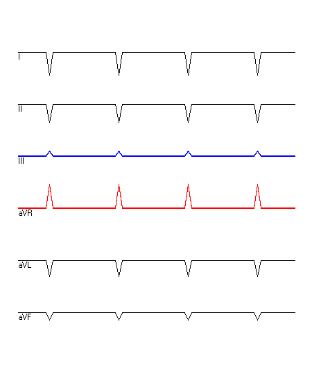 EKG mit hervorgehobenen Ableitungen