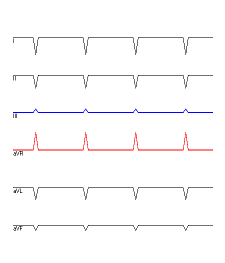 EKG mit hervorgehobenen Ableitungen