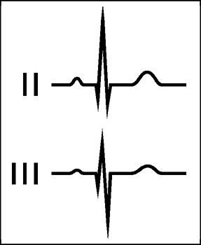 QRS-Komplexe